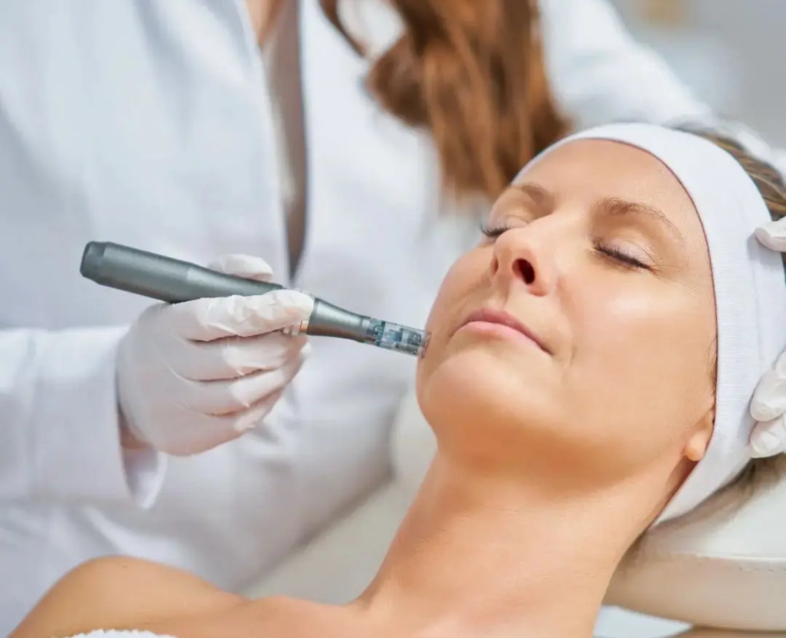 Regular Microneedling with Hyaluronic acid serum (1 Session)